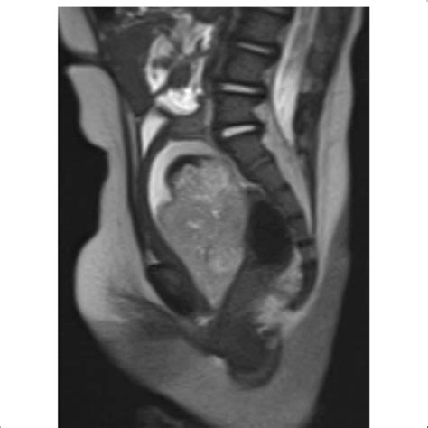 T2 Sagittal Image Of The Tumor At Diagnosis Magnetic Resonance Image