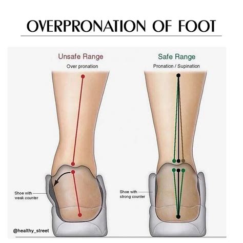 how to fix overpronation of foot