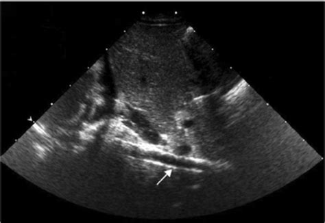 Abdominal X Ray Showing Calcified Descending Aorta Download