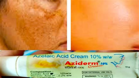 Aziderm Cream Azelic Acid Aziderm 10 Aziderm Cream Full Review Acne Marks