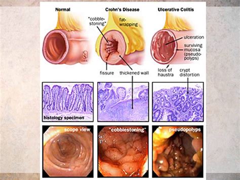 Pathology Part 6 Inflammatory Bowel Disease Dr Mumtaz Sajjd Md Doctorsforafghanistan