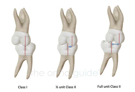 Class Ii Detailed