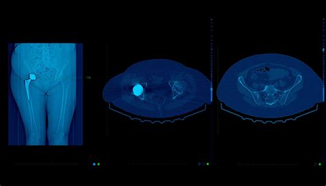 Preparation Low Dose Ct Scan Melbourne Radiology