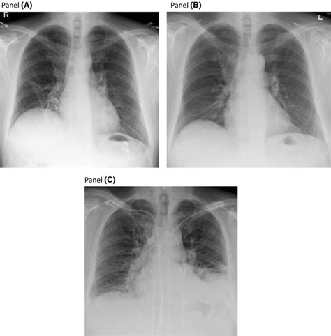 Chest Xrays Of The Presented Patient Panel A Elevated Rightsided