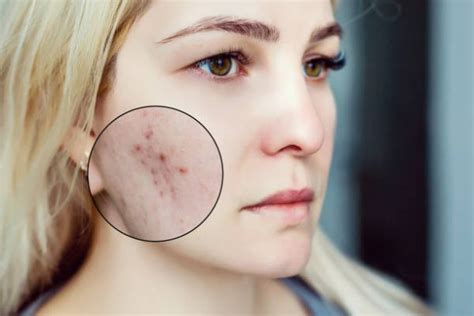 The Five Types Of Acne Scarring And The Best Treatments