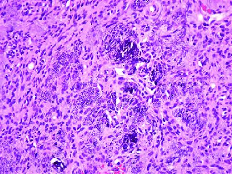 Phosphaturic Mesenchymal Tumour With Bland Myoid Appearing Spindle