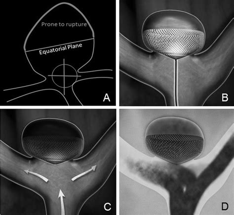 Endovascular Treatment Of Wide Necked Intracranial Aneurysms Using The