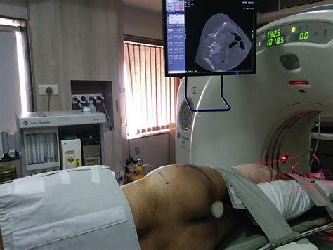 Scielo Brasil Ct Guided Percutaneous Sacroiliac Stabilization In