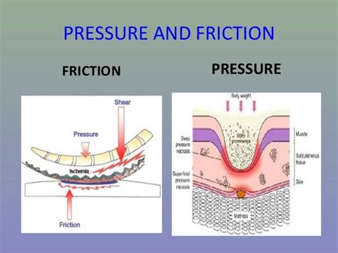 Pressure Sores