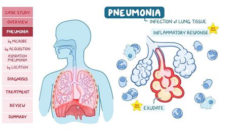 Pneumonia Pathology Review Video Causes And Meaning Osmosis