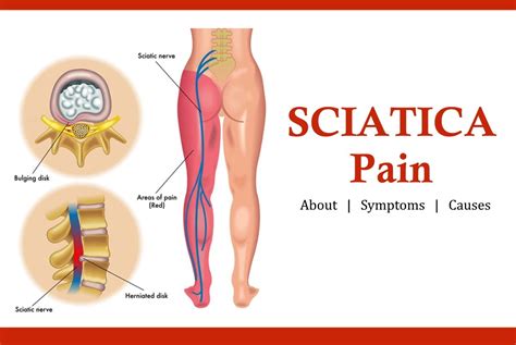 Sciatica pain symptoms and causes