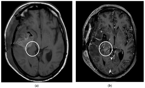 Tomography Free Full Text T1 Weighted Contrast Enhancement