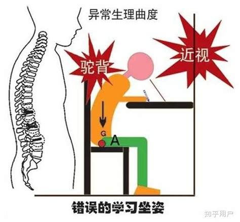 驼背还能救吗？该怎么救？ 知乎