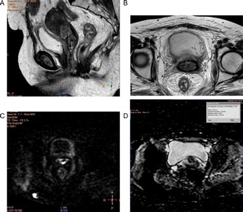 47years Old Female Patient With Cervical Carcinoma Figo Stage Iia A Download Scientific