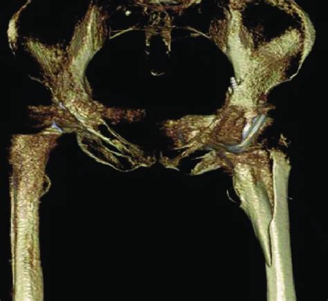 D Ct Showing A Vancouver B Type Periprosthetic Fracture And Varus