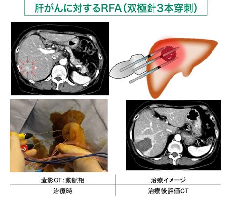 肝臓がん 山口大学大学院 医学系研究科 消化器内科学（第一内科）