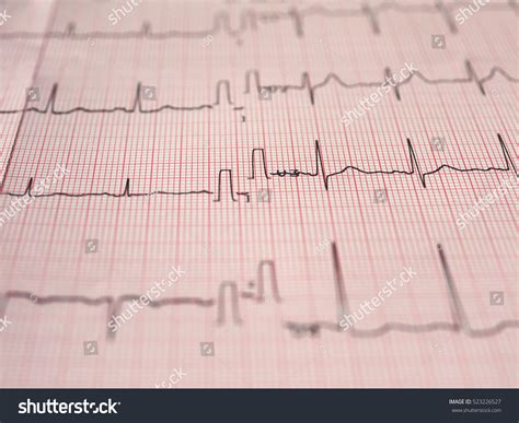 Electrocardiography Aka Ekg Elektrokardiogramm Measure Heartbeat Foto