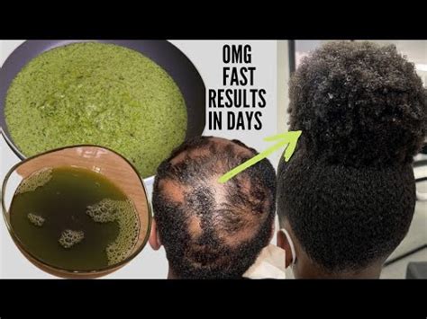 How I Use This Treatments To Grow Back Alopecia Baldness Shedding