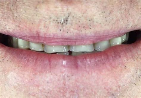 Smile Gallery Before And After Dentures In Surrey Bc