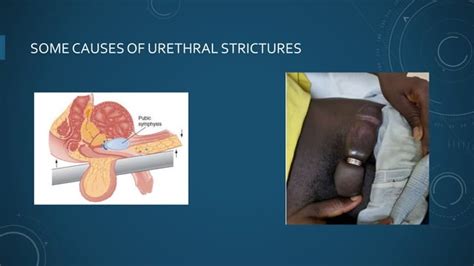 Urethral Strictures Ppt