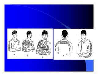 Co Dinh Gay Xuong PDF