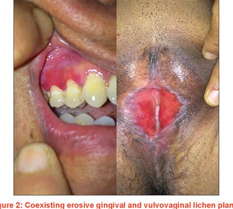 Pdf Classic And Hypertrophic Vulvar Lichen Planus Hot Sex Picture