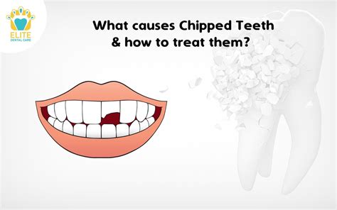 Chipped Teeth Causes And Treatment Elite Dental Care