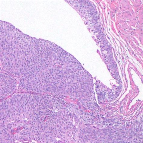 Transitional Cell Carcinoma