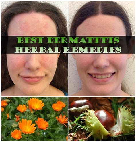 Best Dermatitis Herbal Remedies - SHealthPlus