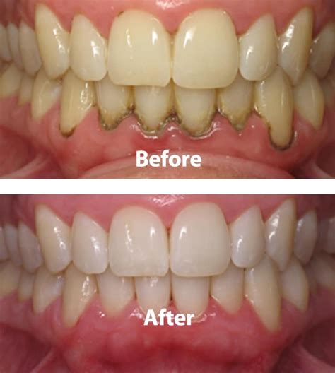 Early Periodontitis Home Treatment