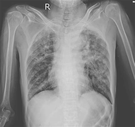 Radiographie Pulmonaire Infiltration Pulmonaire Interstitielle Avec