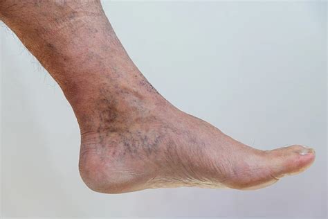 How To Recognize And Treat Irritating Inner Ankle Spider Veins