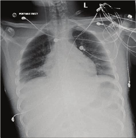 Chest X Ray Ap View Showing Catheter Projected Over Right Atrium And