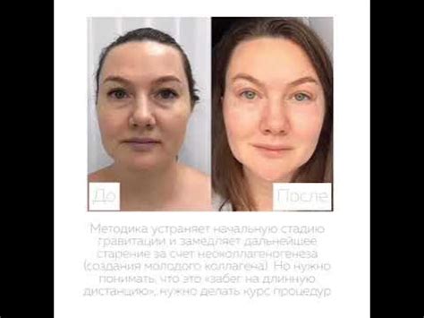 RF-лифтинг и еще 2 эффективных способа избавиться от брылей и второго ...