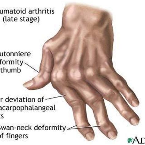 What Is Rheumatoid Arthritis Quizlet