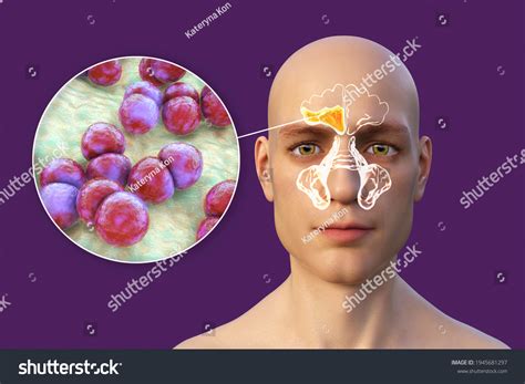 Sinusitis Inflammation Paranasal Cavities 3d Illustration ภาพประกอบ