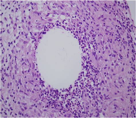 Cystic neutrophilic granulomatous mastitis | Eurorad