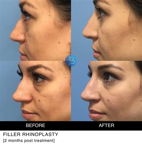 Filler Rhinoplasty 1 Jacob Bloom Md