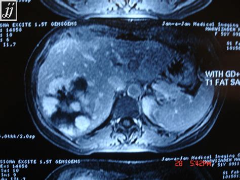 Radioogle Abdomen Giant Cavernous Hemangioma Of The Liver Rare Case 3