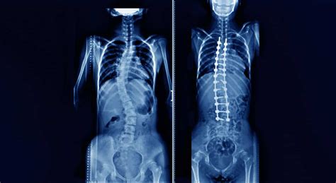 Kyphosis & Scoliosis Correction - Hart Garner, MD - Minnesota Spinal Neurosurgeon