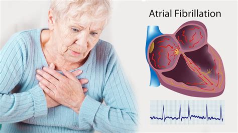 Vitamin D May Protect You From Atrial Fibrillation According To Science