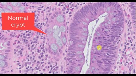 Tubular Adenoma Histology