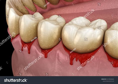 Bleeding Gums Periodontal Pathological Inflammatory Condition Stock