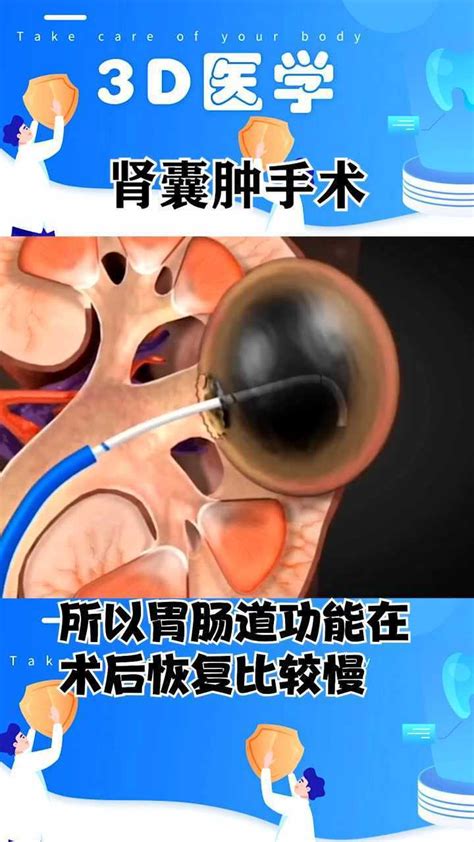 3d医学：肾囊肿手术，看得我肾疼高清1080p在线观看平台腾讯视频