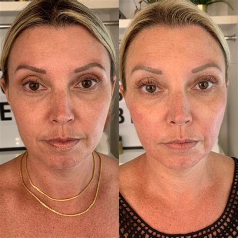 Forma Facial Before And After Transformation