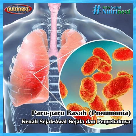 Pneumonia Atau Lebih Dikenal Dengan Sebutan Paru Paru Basah Merupakan