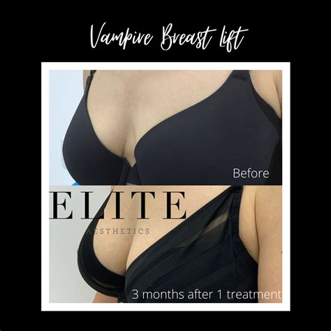 Vampire Breast Lift Uk Perkier Cleavage Elite Aesthetics