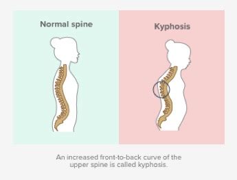 Kyphosis - Huffman Spine Clinic