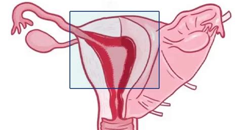 Endometrial Hyperplasia Meaning Types Symptoms Causes Treatment