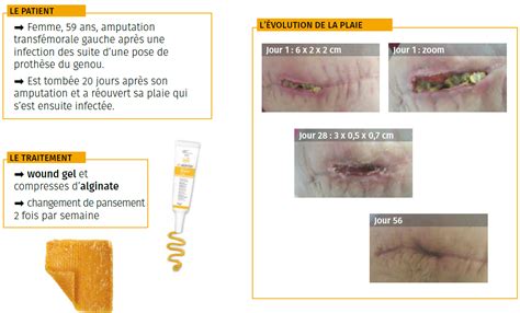 serviteur Plan Éclat pansement alginate au miel de manuka Continent Lac